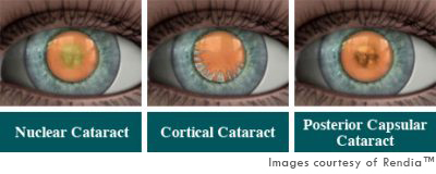Cataract Type
