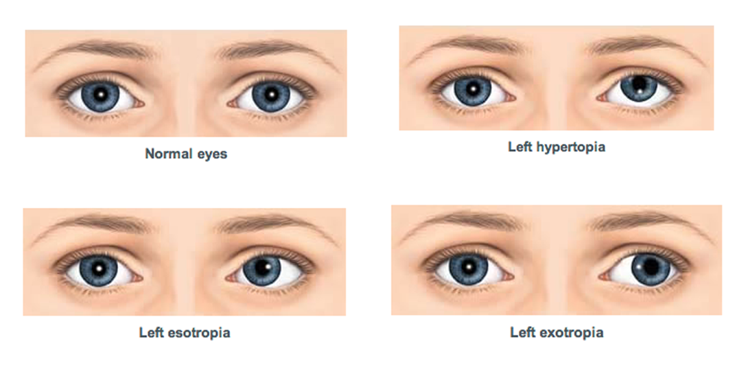 Зрение 10 20. Косоглазие глаза. Косоглазие у взрослых. Экзотропия. Разновидности косоглазия.