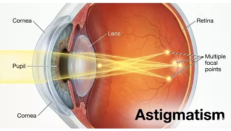 astigmatism