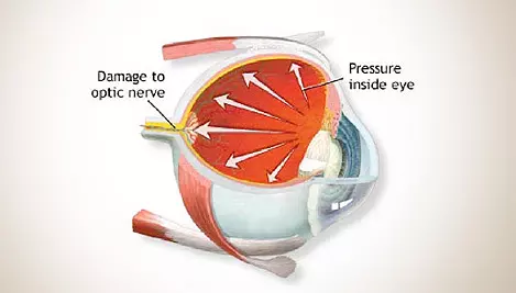 Glaucoma Visualization