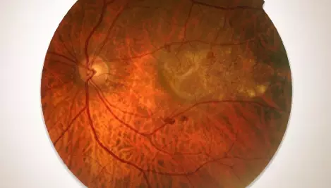 Wet-AMD visualization